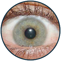 Glaucoma
