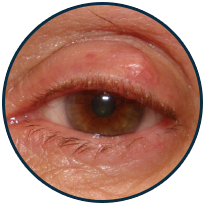 Chalazion
